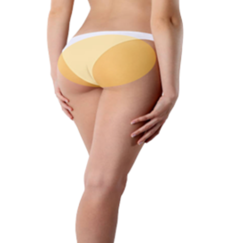 Depilación Laser Glúteos